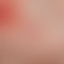 Granuloma pyogenicum (pyogenic granuloma) Rapidly growing, shiny tumour on the palm of the hand. ...