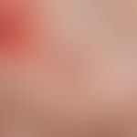 Granuloma pyogenicum (pyogenic granuloma) Rapidly growing, shiny tumour on the palm of the hand. ...