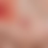 Granuloma pyogenicum (pyogenic granuloma) Rapidly growing, shiny tumour on the palm of the hand. ...