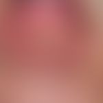 Granuloma pyogenicum (pyogenic granuloma): rapidly growing, shiny, erosive lump on the lower lip....