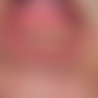 Granuloma pyogenicum (pyogenic granuloma): rapidly growing, shiny, erosive lump on the lower lip....