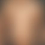 Graft-versus-Host Disease, chronic: 1.5 years after stem cell transplantation, large-area sclerod...