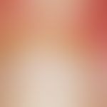 Scleroderma, systemic. reflected light microscopic image with hyperkeratotic nail fold, spatter-l...