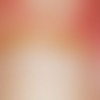 Scleroderma, systemic. reflected light microscopic image with hyperkeratotic nail fold, spatter-l...