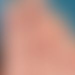 Granuloma anulare subcutaneous type Multiple, painless, deep cutaneous, skin-coloured nodules on ...