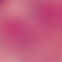 Granuloma anulare: 2 deutlich abgesetzte eosinophile Zonen mit nekrobiotischem Kollagen sowie uml...