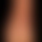 Granuloma anulare giganteum: Centripedally growing, painless, sharply defined, edge-emphasized, r...
