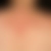 Granuloma anular, disseminated type: densely aggregated small papular form, grouping into anular ...