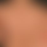 Granuloma anulare perforans: Presence of a disseminated granuloma anulare with multiple shiny pap...