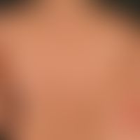 Granuloma anulare perforans:&nbsp;vorliegend ein disseminiertes Granuloma anulare mit multiplen g...