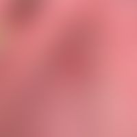 Hyperplasia, focal epithelial: Multiple wart-like, oral mucosa-coloured soft, sometimes confluent...