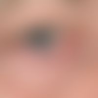 Hidrocystoma, apocrine: Merely cosmetically noticeable and disturbing blue discoloration due to p...