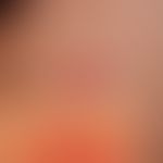 Herpes simplex recidivans: in Abständen von mehreren Monaten rezdivierende Bläschenbildung.
