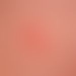 Herpes simplex virus infection: recurrent herpes simplex infection, painful redness over a large ...