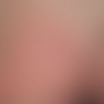 Herpes simplex virus infection: multilocular, recurrent herpes simplex infection on the left butt...