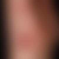 Herpes simplex zosteriformis:&nbsp;untpyisch lokalisierter,&nbsp;segmental angeordneter, multilok...