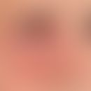Herpes simplex Infektion: schwere perirorbitale Herpes simplex Infektion mit bakterieller Sekundä...