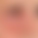 Herpes simplex infection: severe perirbital herpes simplex infection with secondary bacterial inf...