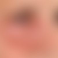 Herpes simplex Infektion: schwere perirorbitale Herpes simplex Infektion mit bakterieller Sekundä...