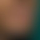 Herpes simplex labialis:ausgedehnte Herpes-simplex-Infektion der Unterlippe mit ausgeprägter koll...