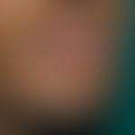 Herpes simplex labialis:extensive herpes simplex infection of the lower lip with pronounced colla...