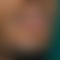 Herpes simplex labialis:extensive herpes simplex infection of the lower lip with pronounced colla...