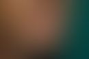 Herpes simplex labialis:ausgedehnte Herpes-simplex-Infektion der Unterlippe mit ausgeprägter koll...