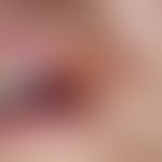 Herpes simplex labialis (secondary bacterial infection): acute, itchy, painful, burning, typicall...