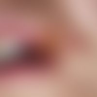 Herpes simplex labialis (secondary bacterial infection): acute, itchy, painful, burning, typicall...