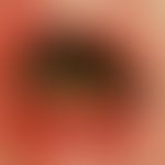 Gingivostomatitis herpetica. An Zunge (durch Pfeile markiert)&nbsp;und Unterlippe (eingekreist)&n...