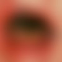 Gingivostomatitis herpetica. An Zunge (durch Pfeile markiert)&nbsp;und Unterlippe (eingekreist)&n...