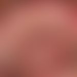 Gingivostomatitis herpetica. Gruppiert stehende, stellenweise konfluierte&nbsp;aphthöse Veränderu...