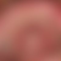 Gingivostomatitis herpetica. Gruppiert stehende, stellenweise konfluierte&nbsp;aphthöse Veränderu...