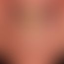 Hair tongue after long-term antibiotic therapy.
