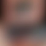 Nagelhämatom: blau-scharze Verfärbung des Großzehennagels. Scharfe Begrenzung nach distal. Keine ...