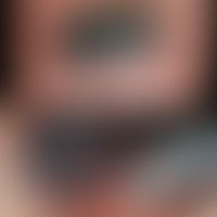 nail hematoma: blue-black discoloration of the big toe nail. sharp limitation distally. no contin...