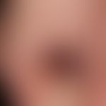 Nagelhämatom: scharf nach distal begrenzte Verfärbung des Großzehennagels. Nagelmatrix am distale...