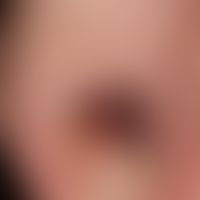 Nagelhämatom: scharf nach distal begrenzte Verfärbung des Großzehennagels. Nagelmatrix am distale...
