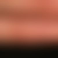Hand-Fuß-Mund-Krankheit. Abgeheilte Blasen bei einer abgelaufenen Erkrankung mit&nbsp; typischer ...