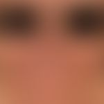Hyperpimgentierungen: chronische flächige Hyperpigmentierungen (Periorbitalregion ausgespart) nac...
