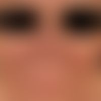 Hyperpigmentations: chronic flat hyperpigmentations (periorbital region excluded) after taking am...
