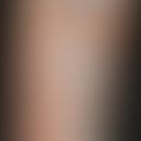 Heparinallergie: positive Testreaktionen bei subkutaner Applikation (Abbildung: PD. H. Dickel Uni...