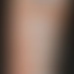 Heparinallergie: positive Testreaktionen bei subkutaner Applikation (Abbildung: PD. H. Dickel Uni...