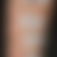 Heparinallergie: positive Testreaktionen bei subkutaner Applikation (Abbildung: PD. H. Dickel Uni...