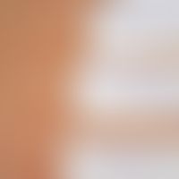 Heparinallergie: positive Epikutan-Testreaktionen &nbsp;(Abbildung: PD. H. Dickel Univ-Hautklinik...