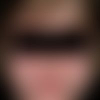 Erworbene generalsierte Hypertrichose nach langzeitiger Therapie mit Ciclosporin.
