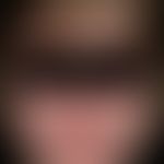 Acquired hypertrichosis after long-term therapy with Ciclosporin

