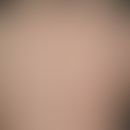 Hypertrichose, erworbene generalisierte: Hypertrichose (Hypertrichosis&nbsp;lanuginosa)&nbsp;nach...