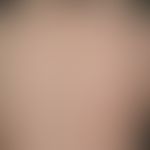 Hypertrichosis, acquired generalized: Hypertrichosis (Hypertrichosis lanuginosa) after several ye...