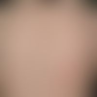 Hypertrichosis, acquired generalized: Hypertrichosis (Hypertrichosis lanuginosa) after several ye...